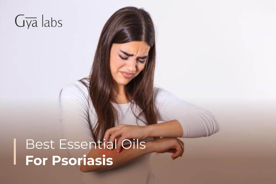 best essential oils for psoriasis