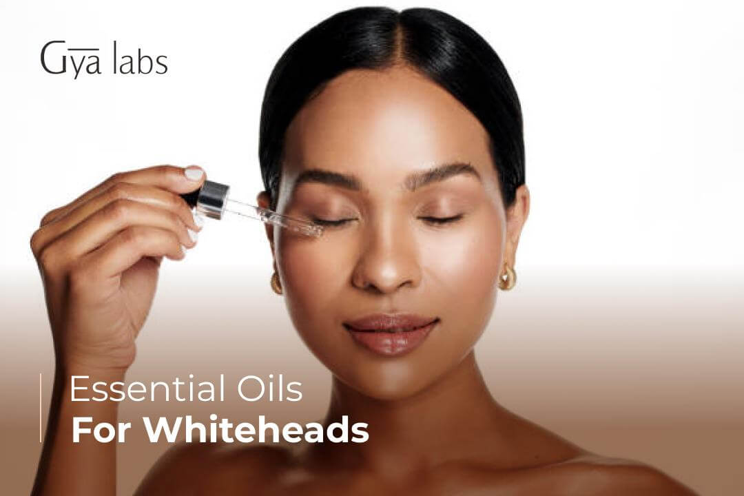 essential oils for whiteheads